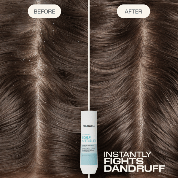 kopfhaut-mit-schuppen-vorher-und-nachher-mit-goldwell-dualsenses-scalp-specialist-anti-dandruff-shampoo